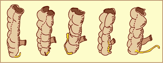 Pic. 73: The human vermiform appendix
(Zum Vergrern anklicken)